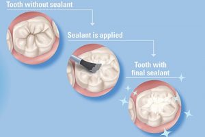 Doctor Staci Talks Sealants in a guest blog for Ask the Dentist!